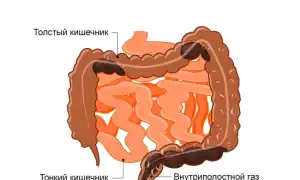 Запор