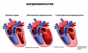Кардиомиопатии