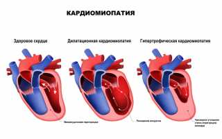 Кардиомиопатии