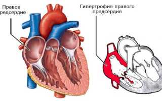 Признаки гипертрофии правого предсердия, лечение, профилактика