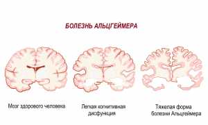 Болезнь Альцгеймера