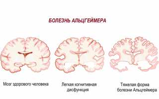 Болезнь Альцгеймера
