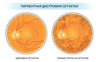 Дистрофия сетчатки глаза