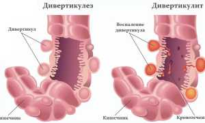 Дивертикулит
