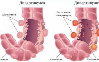 Дивертикулит
