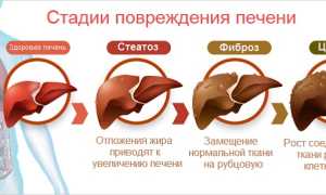 Стеатоз