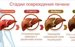 Стеатоз