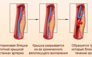 Как распознать сердечный приступ, его признаки, способы лечения и профилактики